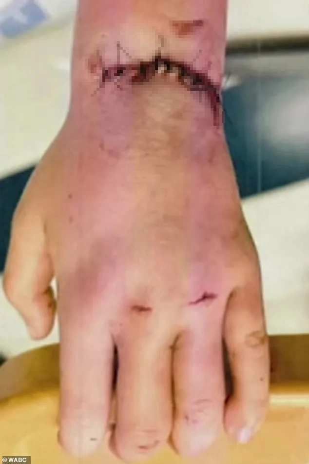 Hình ảnh cánh tay bị thương nghiêm trọng sau tai nạn của bé gái 5 tuổi tại Mỹ